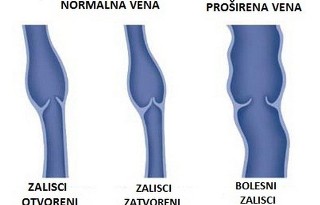 Zašto nastaju proširene vene