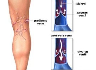 Prosirene vene – uzroci, simptomi, lecenje, oporavak